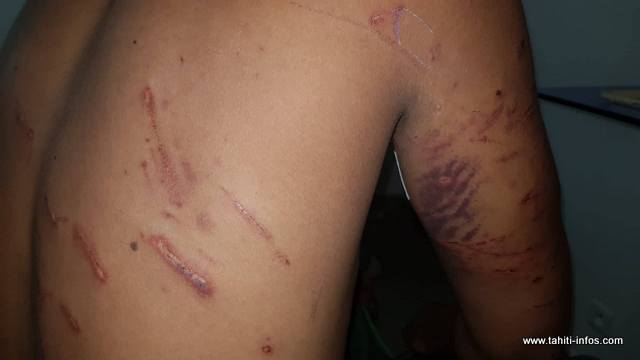 Le jeune homme de 17 ans a bien été mordu.