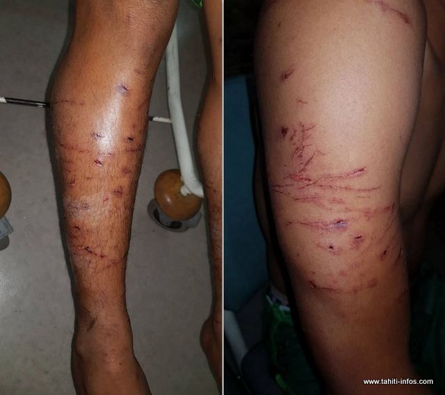 Six chiens s'en sont pris à ses bras et à ses jambes.