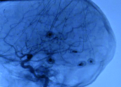 AVC, démence ou Parkinson: 1 femme sur 2 et 1 homme sur 3 à risque