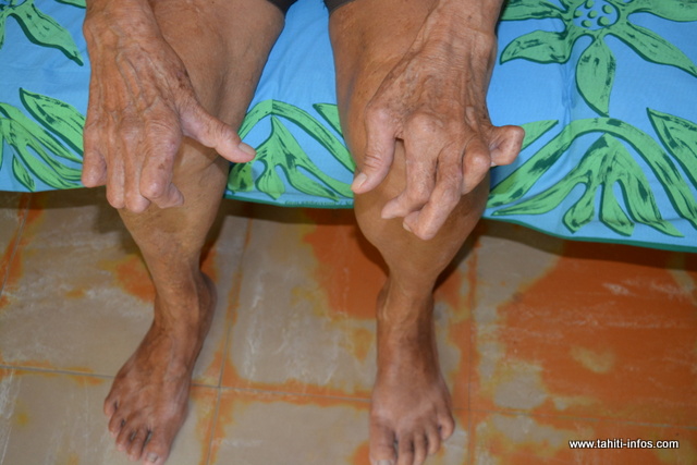 La lèpre circule toujours en Polynésie 