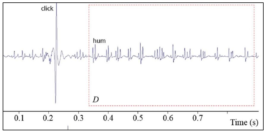 Oscillogrammes représentant les « hums » et « clics »