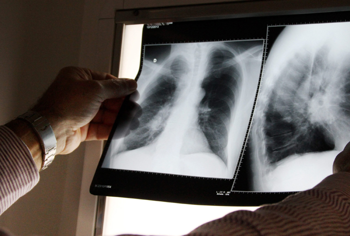 Pour dépister une tuberculose deux examens sont prescrits : un test cutané et une radio des poumons