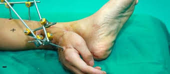 La main d'un Chinois greffée provisoirement sur sa jambe avant de retrouver son poignet