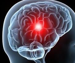 Attaque cérébrale: les femmes de tous les âges plus à risque que les hommes