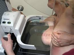 Mammographie: avantages surestimés, risques sous-estimés