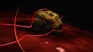 USA: un cancer guéri par une dose massive de virus modifiés de la rougeole