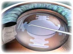 Cataracte: les ophtalmologues craignent une chirurgie au rabais