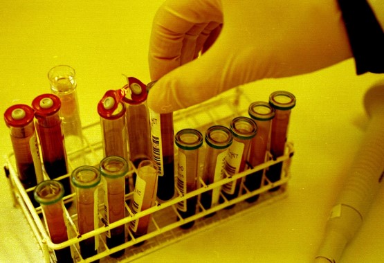 Sida : le bébé américain "guéri" grâce aux antirétroviraux testé séropositif