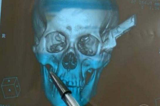 Un Brésilien de 39 ans a reçu plusieurs coups de couteau de 30 cm. La lame est restée plantée dans sa tête mais il va bien. LP/G1 news