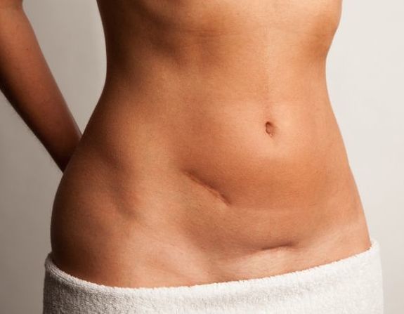 « Le traitement des cicatrices par thérapie manuelle », par Karine Wong, chiropracteur de Papeete