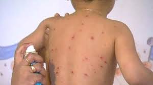 La rougeole peut affaiblir le système immunitaire des enfants pendant 3 ans
