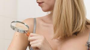 Onze grains de beauté sur le bras droit ? Vous risquez un mélanome