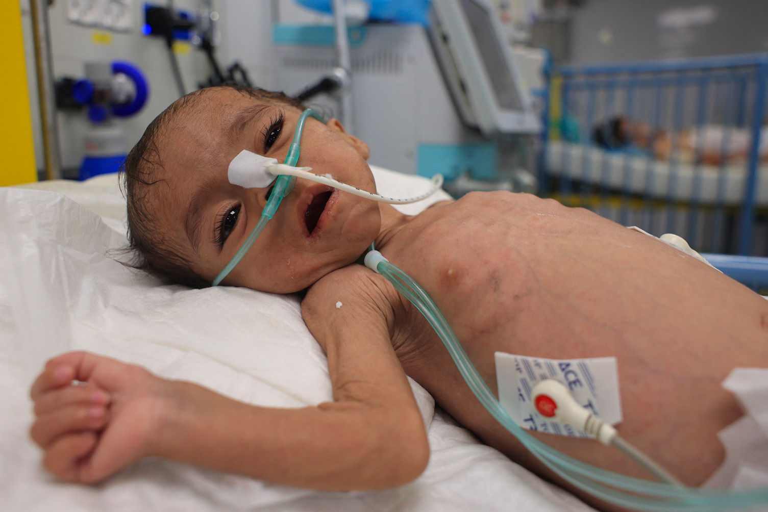 Un enfant palestinien souffrant de malnutrition est soigné à l'hôpital Nasser de Khan Yunis, dans le sud de la bande de Gaza, le 10 juillet 2024, dans le cadre du conflit entre Israël et le groupe militant palestinien Hamas. Eyad BABA / AFP