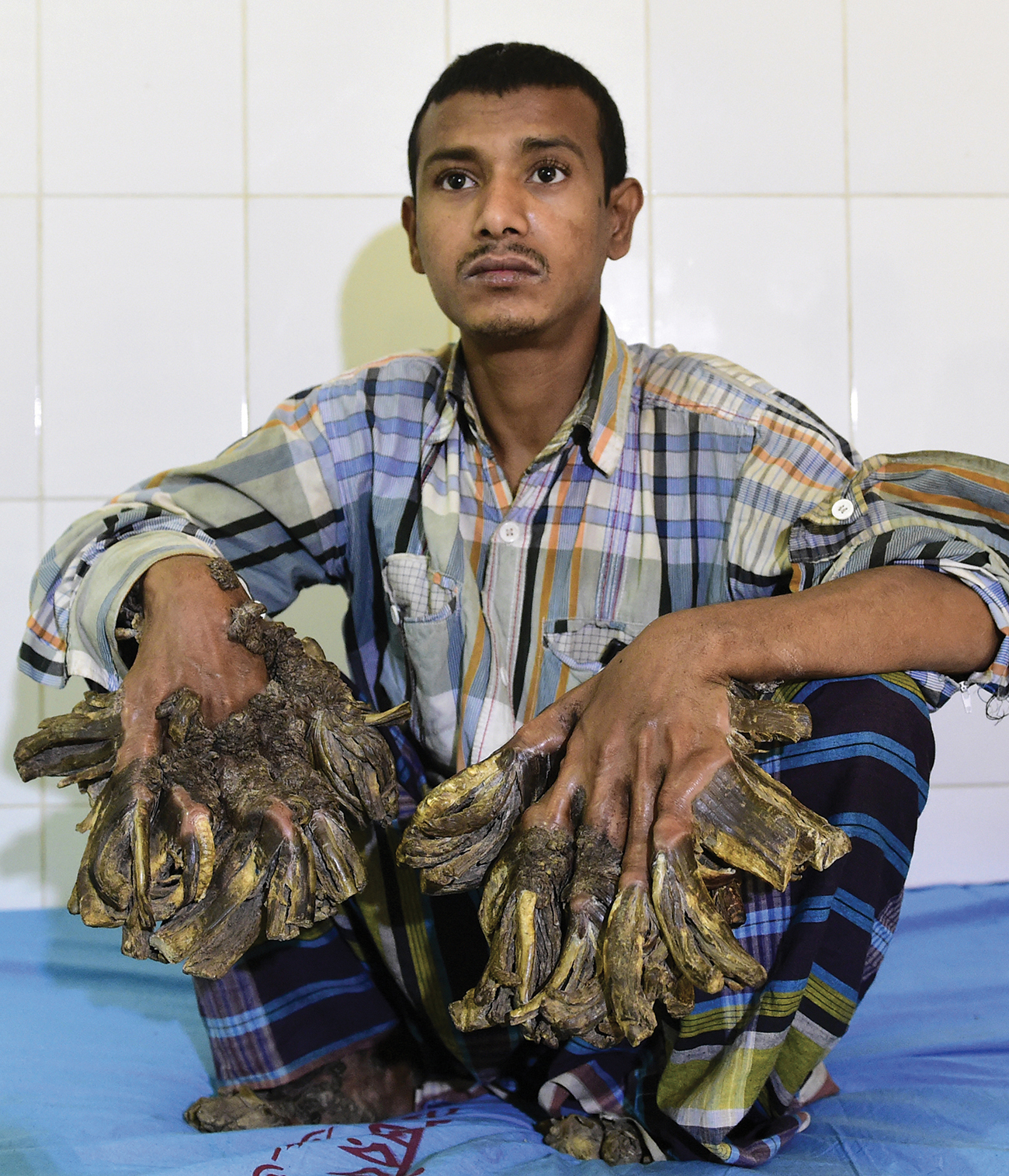 Bangladesh: un "homme-arbre" aux excroissances impressionnantes opéré