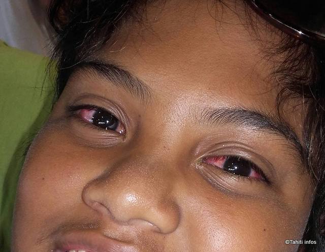 Selon le service de veille sanitaire, l'épidémie de conjonctivite se stabilise