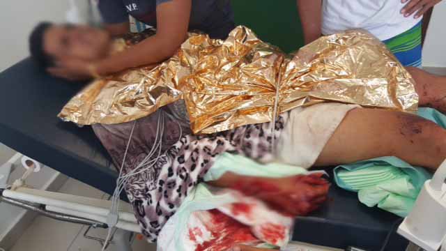 Le jeune pêcheur grièvement mordu au pied doit être évacué d'urgence vers Tahiti.photo Felix Tokoragi