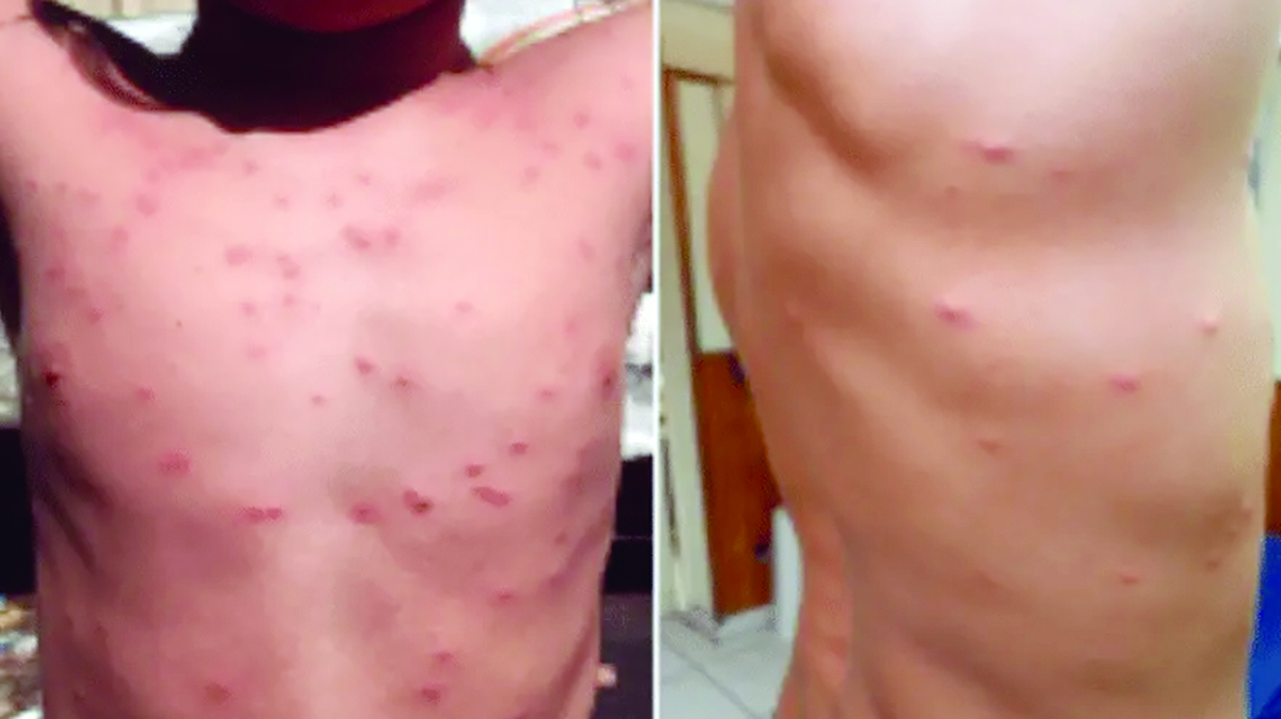 Deux cas de dermatite du surfeur signalés à Papara