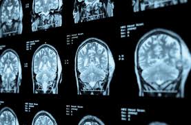 Un haut niveau d'études serait associé à un risque accru de tumeurs du cerveau