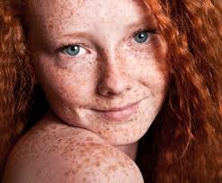 Le risque de cancer de la peau possiblement accru par un gène chez les roux