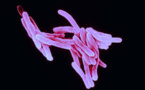 L'épidémie de tuberculose plus grave qu'on ne le pensait