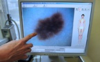 Australie: des chercheurs développent un test sanguin pour détecter le mélanome