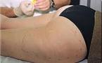 Cellulite: des techniques alternatives à la chirurgie vont être interdites