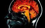 Alzheimer: le cerveau commencerait à se réduire 10 ans avant le diagnostic