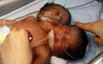 Naissance d'un enfant à deux têtes en Chine