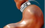 Réduction de l'estomac: moins d'accidents cardio-vasculaires et de mortalité