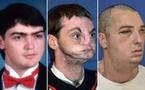 Greffe spectaculaire du visage aux Etats-Unis, la plus étendue à ce jour