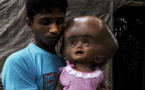 Inde : une petite fille au crâne hypertrophié suscite un élan de solidarité