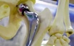 Après les implants mammaires PIP, des prothèses de hanche sur la sellette