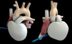 Première implantation du coeur artificiel français Carmat
