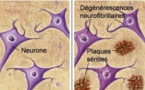 Un diagnostic précoce et simplifié de la maladie d'Alzheimer