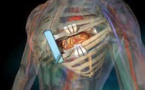 Le pontage coronarien meilleure option dans certains cas que l'angioplastie