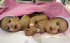 Des bébés siamois afghans séparés avec succès à Kaboul