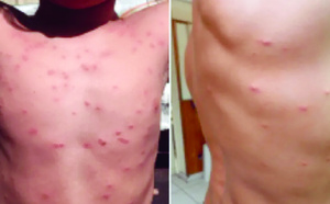 Deux cas de dermatite du surfeur signalés à Papara