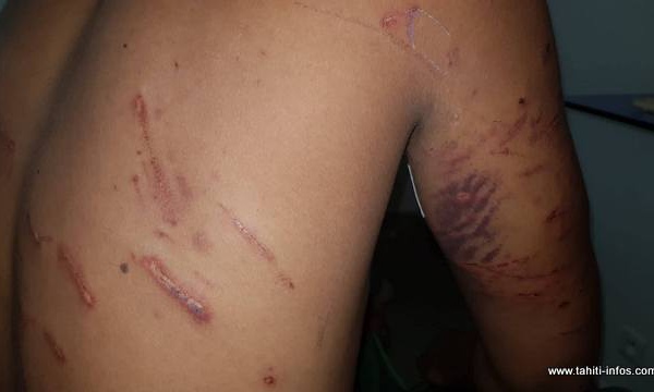 Pirae : mordu par sept chiens errants