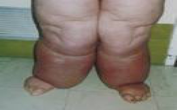 Lutte contre la filariose,  une priorité de santé publique