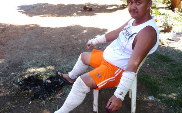 Attaque de chiens à Faa’a : « J’ai cru que c’était ma dernière heure »