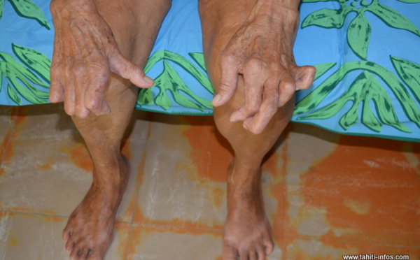 La lèpre circule toujours en Polynésie 