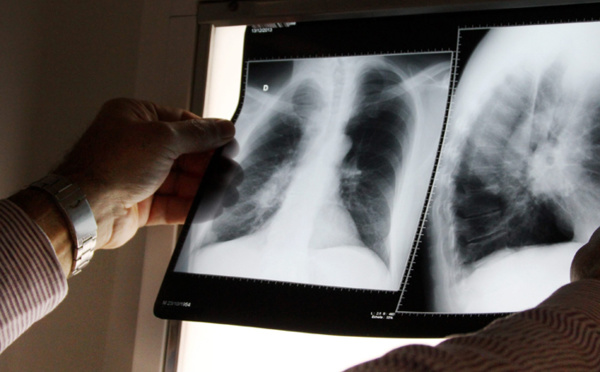 Tuberculose, une maladie grave qui se soigne