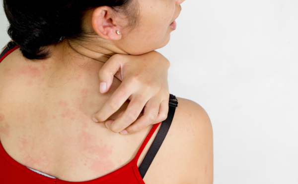 Zika : la diffusion de l’épidémie est très rapide