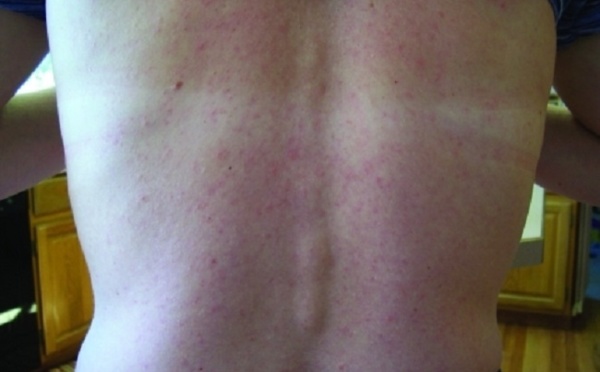 L’épidémie de zika en Polynésie va permettre de mieux connaître ce virus