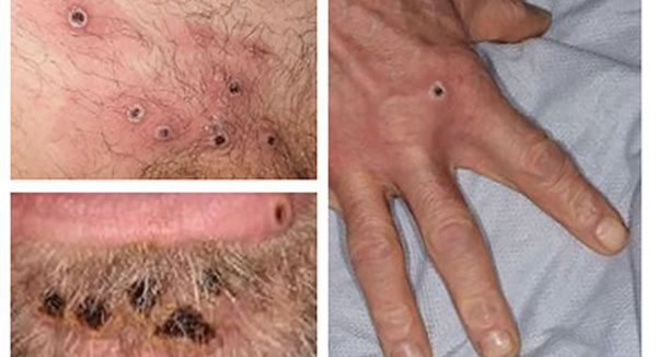 Un cas de variole du singe détecté en Nouvelle-Calédonie