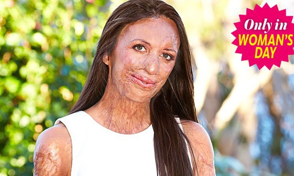 Nouvelle opération chirurgicale pour Turia Pitt
