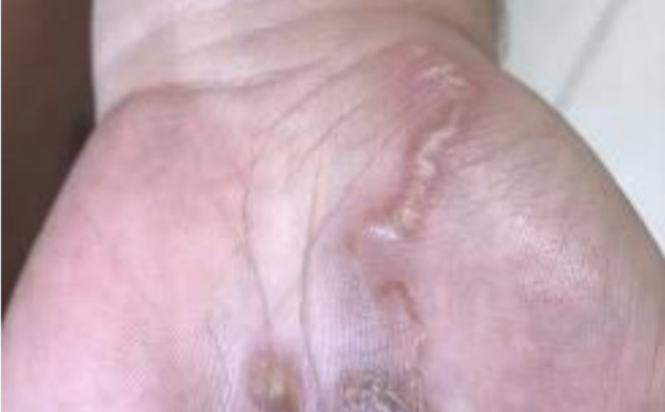 4 cas de larva migrans