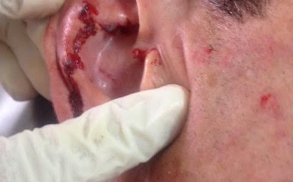 Rikitea : Il mord sa victime au visage