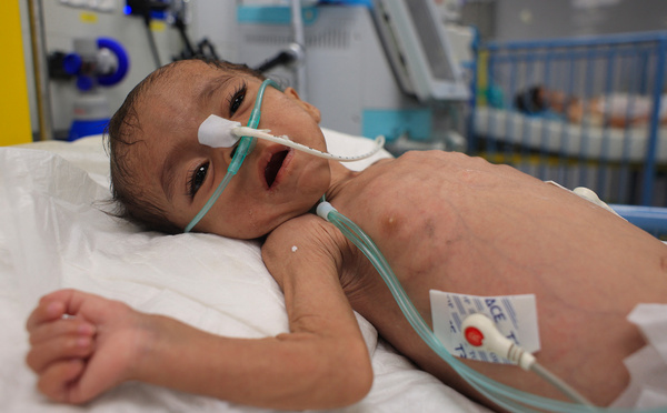 La malnutrition aiguë s'étend sous l'effet des conflits, sombres perspectives pour 2025