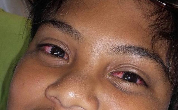 L'épidémie de conjonctivite se stabilise sur le fenua